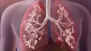 غربالگری ناقلان فیبروز کیستیک (Cystic Fibrosis)
