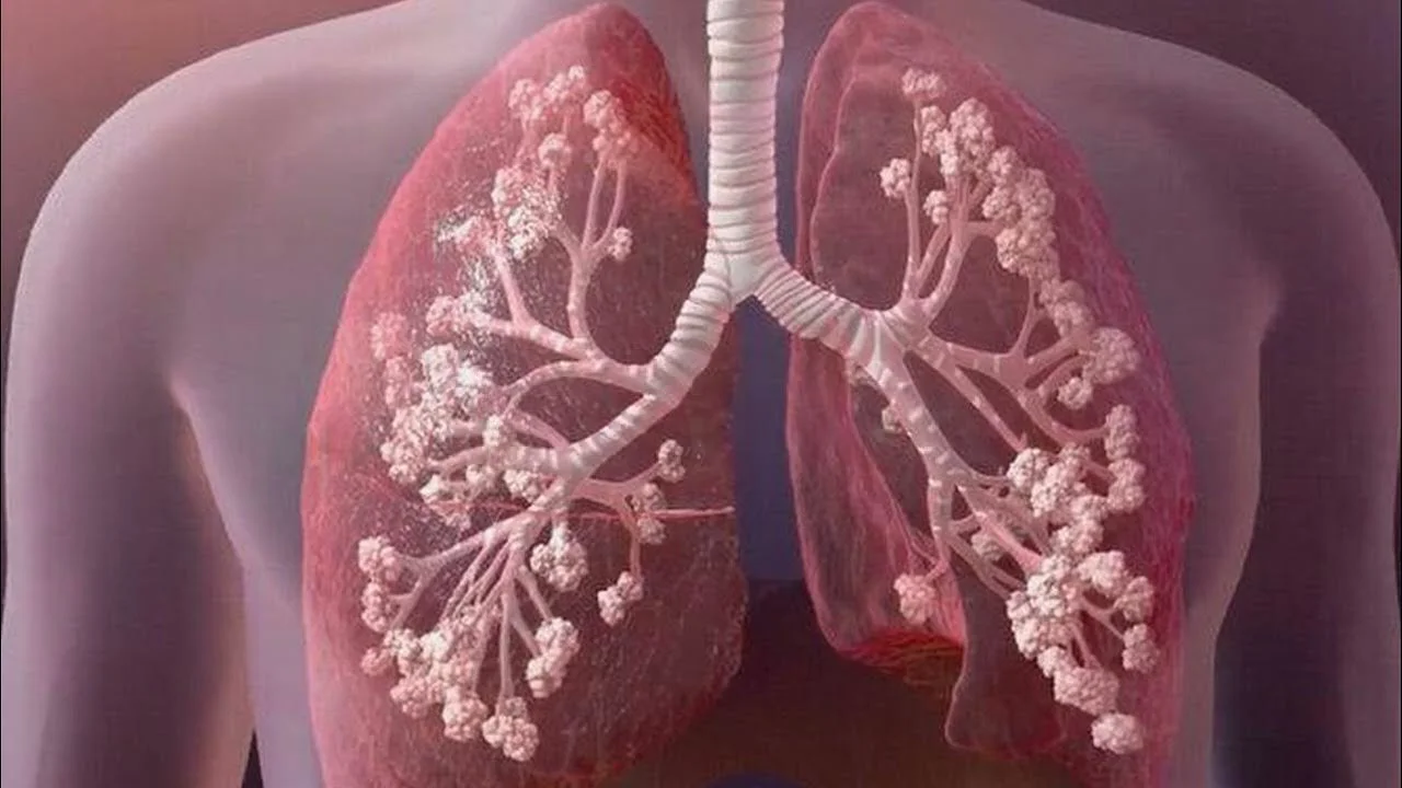 غربالگری ناقلان فیبروز کیستیک (Cystic Fibrosis)